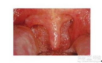 喉炎可以吃白瓜吗,白瓜的食疗作用解析